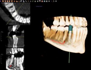 Dental implant imaging - Omaha, NE