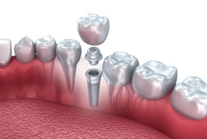 an image of a dental implant post going through osseointegration, with the abutment and dental crown hovering over the dental implant  