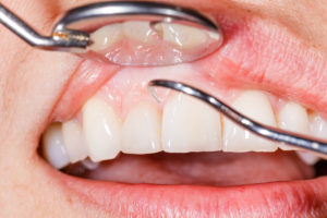 Can Periodontitis Be Cured?
