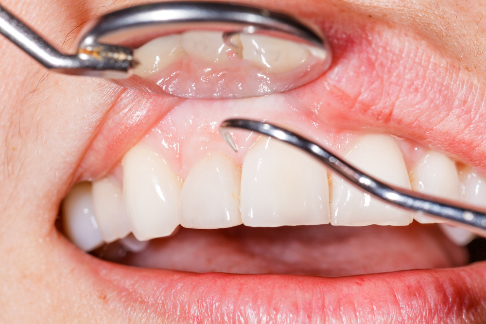 a patients teeth and gums being examined with dental tools for periodontitis