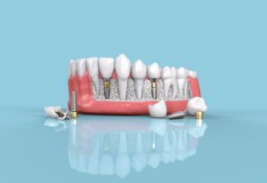 Three Exciting Benefits of Dental Implants