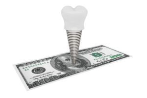 Dental Implant Cost Factors