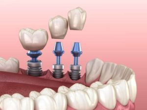 walking through the implant procedure