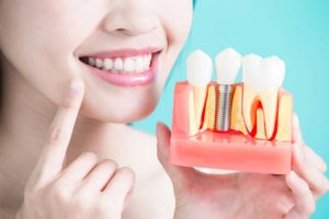 patient holding a model of a placed dental implant