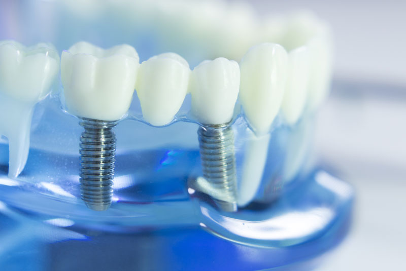 Dental Implant Model