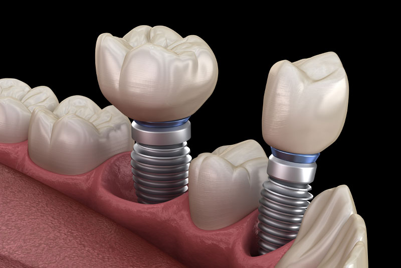 Dental Implants in Mouth