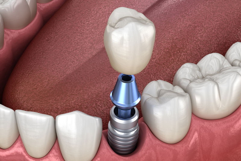 Dental Implant in Your Mouth