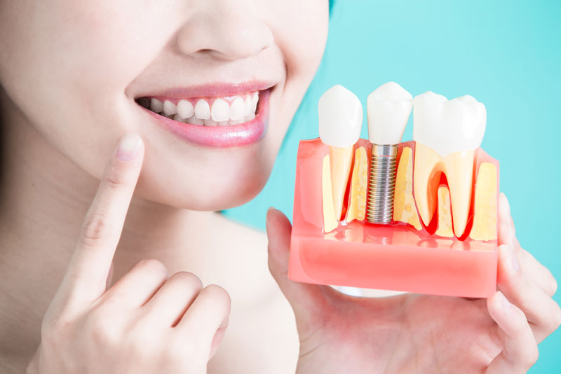 How To Take Care Of Your Dental Implants