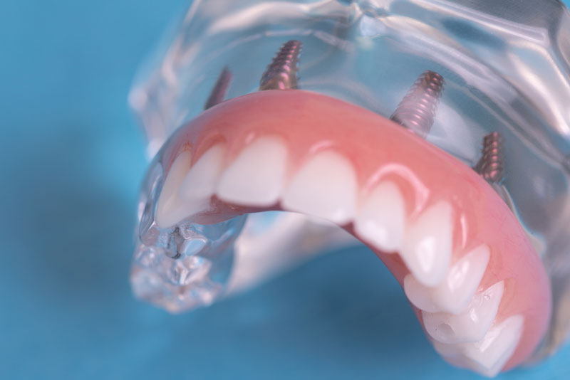 Implant Supported Denture Model