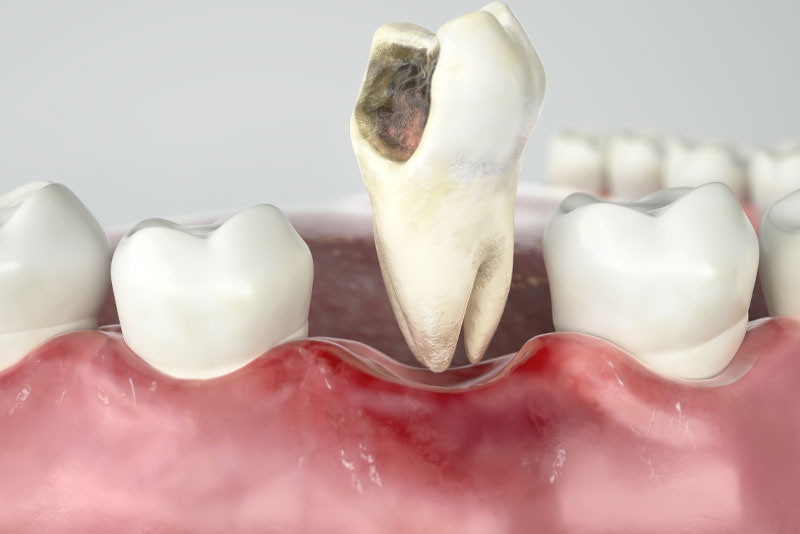 damaged tooth model that needs to be fixed by an oral surgeon