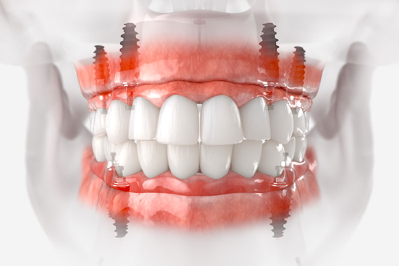 a digital preview of full arch dental implants.