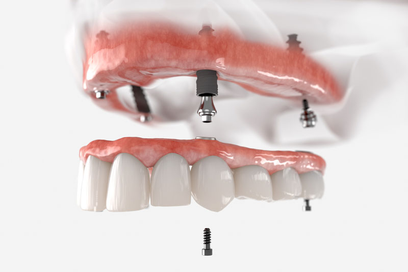 an image of a full mouth dental implant model for the upper arch showing four dental implant posts an oral surgeon can place in the gum line and the full arch prosthetic hovering over the dental implants.