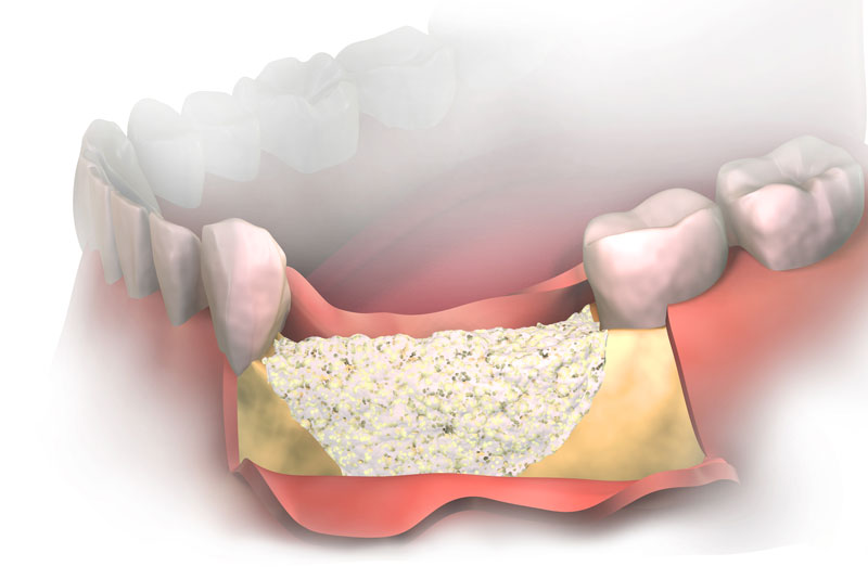 a bone grafting procedure digital model.