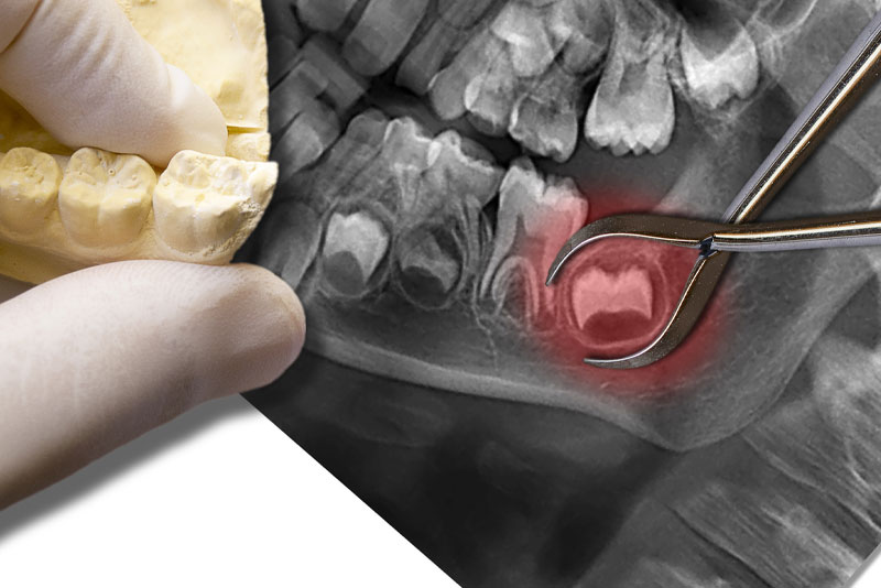 an xray showing an impacted wisdom tooth ready for removal.