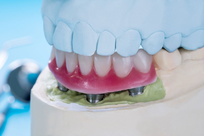 an implant supported denture model.