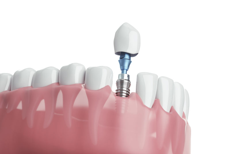 a digital model of a lower arch receiving a single dental implant.