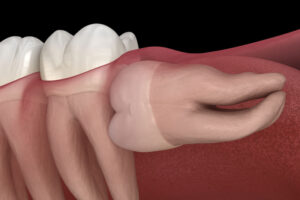 An image of a wisdom tooth that needs removed.