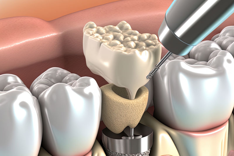 3d image of a dental implant.