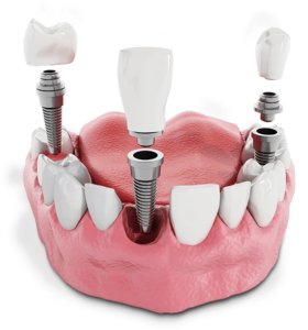 Multiple Dental Implants Above Gumline Graphic