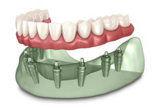 full arch dental implant model.