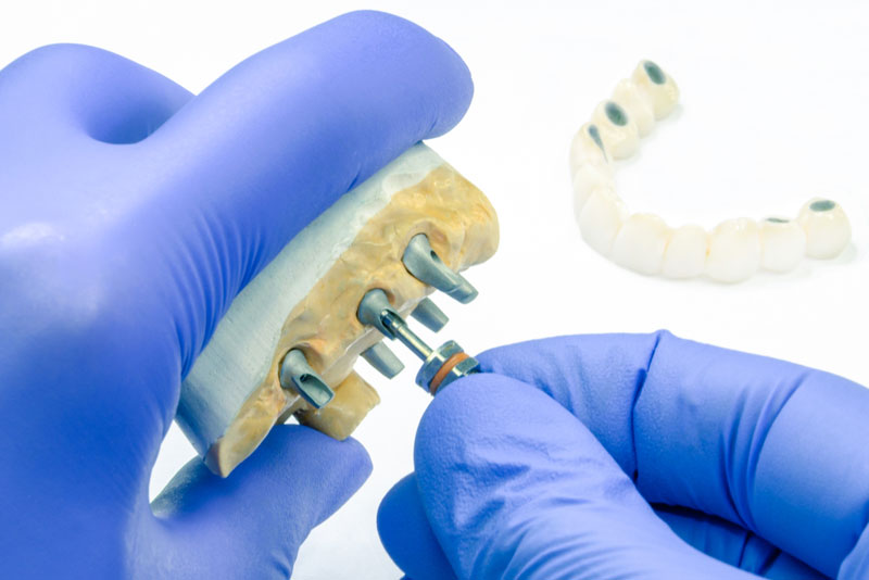 a dental implant model being custom made by a dentist in omaha ne.