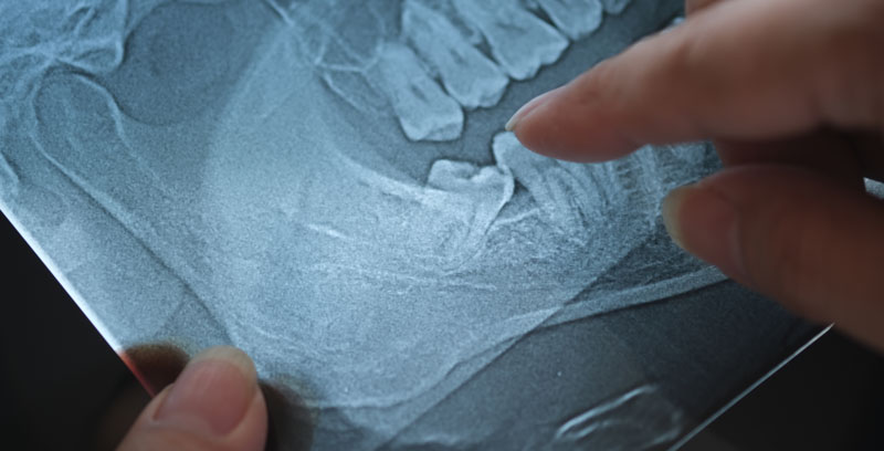Panoramic x-ray image of teeth and mouth with wisdom teeth, wisdom teeth need to be removed based on the position of the tooth in the xray