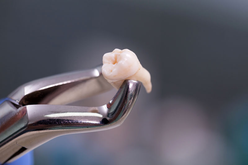 Dental equipment holding an extracted tooth.