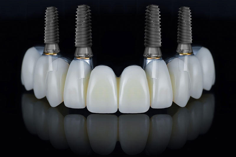 All-on-4 dental implants shown on a black background, highlighting the full-arch prosthetic secured by four implant posts for complete tooth replacement.