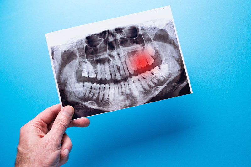 A dentist points to a problem area on a dental X-ray, highlighted in red. Concept of toothache and dental examination.